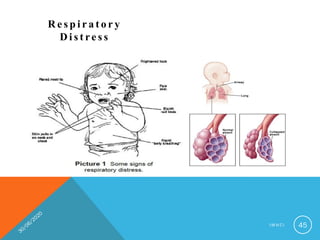 R e s p i r a t o r y
D i s t re s s
I M N C I 45
 