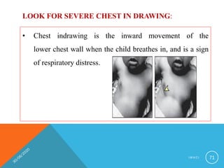 • Chest indrawing is the inward movement of the
lower chest wall when the child breathes in, and is a sign
of respiratory distress.
LOOK FOR SEVERE CHEST IN DRAWING:
I M N C I 71
 
