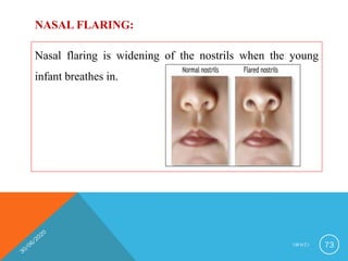Nasal flaring is widening of the nostrils when the young
infant breathes in.
NASAL FLARING:
I M N C I 73
 
