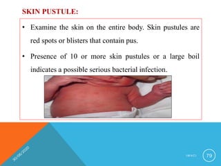 SKIN PUSTULE:
• Examine the skin on the entire body. Skin pustules are
red spots or blisters that contain pus.
• Presence of 10 or more skin pustules or a large boil
indicates a possible serious bacterial infection.
I M N C I 79
 