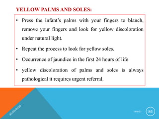 YELLOW PALMS AND SOLES:
• Press the infant’s palms with your fingers to blanch,
remove your fingers and look for yellow discoloration
under natural light.
• Repeat the process to look for yellow soles.
• Occurrence of jaundice in the first 24 hours of life
• yellow discoloration of palms and soles is always
pathological it requires urgent referral.
I M N C I 86
 
