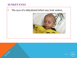 • The eyes of a dehydrated infant may look sunken.
SUNKEN EYES
I M N C I 89
 