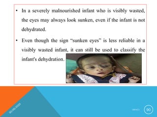 • In a severely malnourished infant who is visibly wasted,
the eyes may always look sunken, even if the infant is not
dehydrated.
• Even though the sign “sunken eyes” is less reliable in a
visibly wasted infant, it can still be used to classify the
infant's dehydration.
I M N C I 90
 