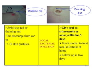 •Umbilicus red or
draining pus
•Pus discharge from ear
or
•< 10 skin pustules
LOCAL
BACTERIAL
INFECTION
Give oral co-
trimoxazole or
amoxycillin for 5
days
Teach mother to treat
local infections at
home
Follow up in two
days
Umbilicus red
Draining
pus
22
 
