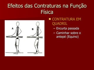 Efeitos das Contraturas na Função Física CONTRATURA EM QUADRIL Encurta passada Caminhar sobre o antepé (Equino) 