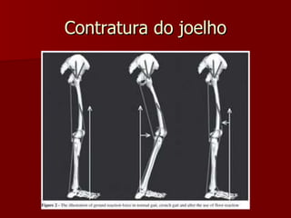 Contratura do joelho 