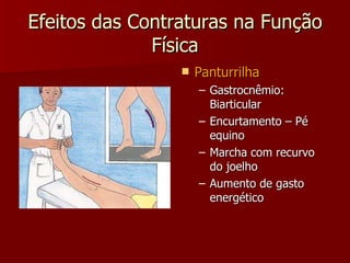 Efeitos das Contraturas na Função Física Panturrilha Gastrocnêmio: Biarticular Encurtamento – Pé equino Marcha com recurvo do joelho Aumento de gasto energético 