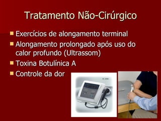 Tratamento Não-Cirúrgico Exercícios de alongamento terminal Alongamento prolongado após uso do calor profundo (Ultrassom) Toxina Botulínica A Controle da dor 