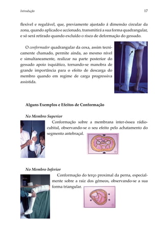 Introdução 	                                                         17


flexível e regulável, que, previamente ajustado á dimensão circular da
zona, quando aplicado e accionado, transmitirá a sua forma quadrangular,
e só será retirado quando excluído o risco de deformação do gessado.

   O conformador quadrangular da coxa, assim tecni­
ca­ ente chamado, permite ainda, ao mesmo nível
  m
e simultaneamente, realizar na parte posterior do
gessado apoio isquiático, tornando-se manobra de
grande importância para o efeito de descarga do
membro quando em regime de carga progressiva
assistida.




   Alguns Exemplos e Efeitos de Conformação

   No Membro Superior
                Conformação sobre a membrana inter-óssea rádio-
             cubital, observando-se o seu efeito pelo achatamento do
             segmento antebraçal.




   No Membro Inferior
                   Conformação do terço proximal da perna, especial­
                mente sobre a raiz dos gémeos, observando-se a sua
                forma triangular.
 