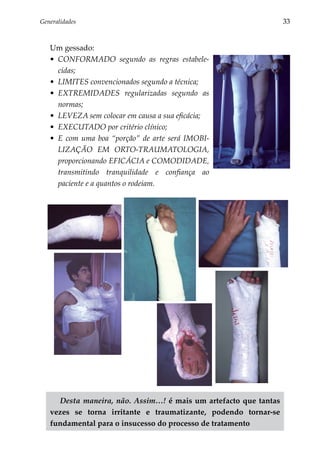 Generalidades	                                                    33


   Um gessado:
   •	 CONFORMADO segundo as regras estabele­
      cidas;
   •	 LIMITES convencionados segundo a técnica;
   •	 EXTREMIDADES regularizadas segundo as
      normas;
   •	 LEVEZA sem colocar em causa a sua eficácia;
   •	 EXECUTADO por critério clínico;
   •	 E com uma boa “porção” de arte será IMOBI­
      LIZAÇÃO EM ORTO-TRAU­ ATOLOGIA,  M
      proporcionando EFICÁCIA e COMODIDADE,
      transmi­ indo tranquilidade e confiança ao
               t
      pacien­ e e a quantos o rodeiam.
             t




     Desta maneira, não. Assim…! é mais um artefacto que tantas
   vezes se torna irritante e traumatizante, podendo tornar-se
   fundamental para o insucesso do processo de tratamento
 