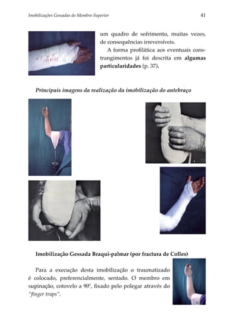 Imobilizações Gessadas do Membro Superior	                                  41


                                    um quadro de sofrimento, muitas vezes,
                                    de consequências irreversíveis.
                                       A forma profilática aos eventuais cons­
                                    tran­ imentos já foi descrita em algumas
                                        g
                                    particularidades (p. 37).



   Principais imagens da realização da imobilização do antebraço




   Imobilização Gessada Braqui-palmar (por fractura de Colles)

   Para a execução desta imobilização o traumatizado
é colocado, preferencialmente, sentado. O membro em
supinação, cotovelo a 90º, fixado pelo polegar através do
“finger traps”.
 