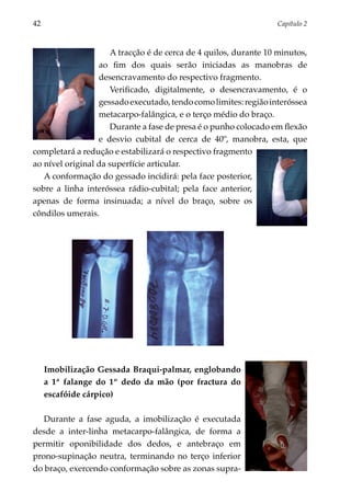 42	                                                               Capítulo 2



                     A tracção é de cerca de 4 quilos, durante 10 minutos,
                  ao fim dos quais serão iniciadas as manobras de
                  desencravamento do respectivo fragmento.
                     Verificado, digitalmente, o desencravamento, é o
                  gessado executado, tendo como limites: região interóssea
                  metacarpo-falângica, e o terço médio do braço.
                     Durante a fase de presa é o punho colocado em flexão
                  e desvio cubital de cerca de 40º, manobra, esta, que
completará a redução e estabilizará o respectivo fragmento
ao nível original da superfície articular.
   A conformação do gessado incidirá: pela face posterior,
sobre a linha interóssea rádio-cubital; pela face anterior,
apenas de forma insinuada; a nível do braço, sobre os
côndilos umerais.




      Imobilização Gessada Braqui-palmar, englobando
      a 1ª falange do 1º dedo da mão (por fractura do
      escafóide cárpico)

   Durante a fase aguda, a imobilização é executada
desde a inter-linha metacarpo-falângica, de forma a
permitir oponibilidade dos dedos, e antebraço em
prono-supinação neutra, terminando no terço inferior
do braço, exercendo conformação sobre as zonas supra-
 