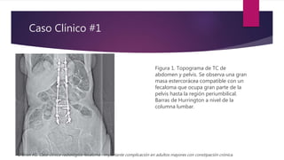 Caso Clínico #1
Figura 1. Topograma de TC de
abdomen y pelvis. Se observa una gran
masa estercorácea compatible con un
fecaloma que ocupa gran parte de la
pelvis hasta la región periumbilical.
Barras de Hurrington a nivel de la
columna lumbar.
O'Brien AS. Caso clínico radiológico fecaloma : importante complicación en adultos mayores con constipación crónica.
 