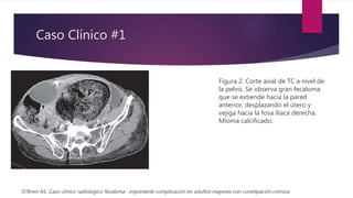 Caso Clínico #1
Figura 2. Corte axial de TC a nivel de
la pelvis. Se observa gran fecaloma
que se extiende hacia la pared
anterior, desplazando el útero y
vejiga hacia la fosa ilíaca derecha.
Mioma calcificado.
O'Brien AS. Caso clínico radiológico fecaloma : importante complicación en adultos mayores con constipación crónica.
 