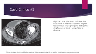 Caso Clínico #1
Figura 3. Corte axial de TC a un nivel más
caudal que el anterior. Se observa un gran
fecaloma que ocupa gran parte de la pelvis
desplazando el útero y vejiga hacia la
derecha.
O'Brien AS. Caso clínico radiológico fecaloma : importante complicación en adultos mayores con constipación crónica.
 
