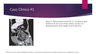 Caso Clínico #1
Figura 4. Reformateo coronal de TC. Se observa gran
fecaloma de 20 cm en el eje cráneo-caudal, con
desplazamiento de la vejiga hacia la derecha.
O'Brien AS. Caso clínico radiológico fecaloma : importante complicación en adultos mayores con constipación crónica.
 