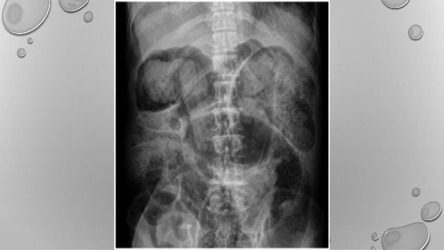 Impactacion fecal