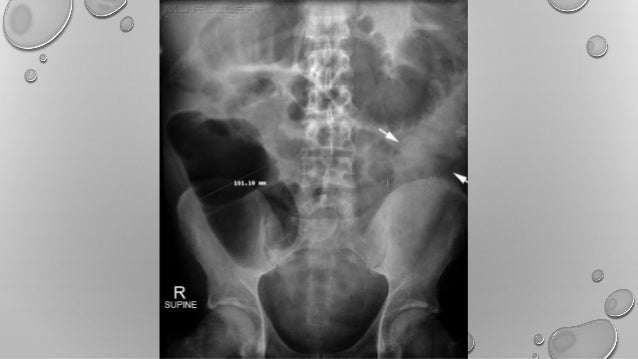 Impactacion fecal