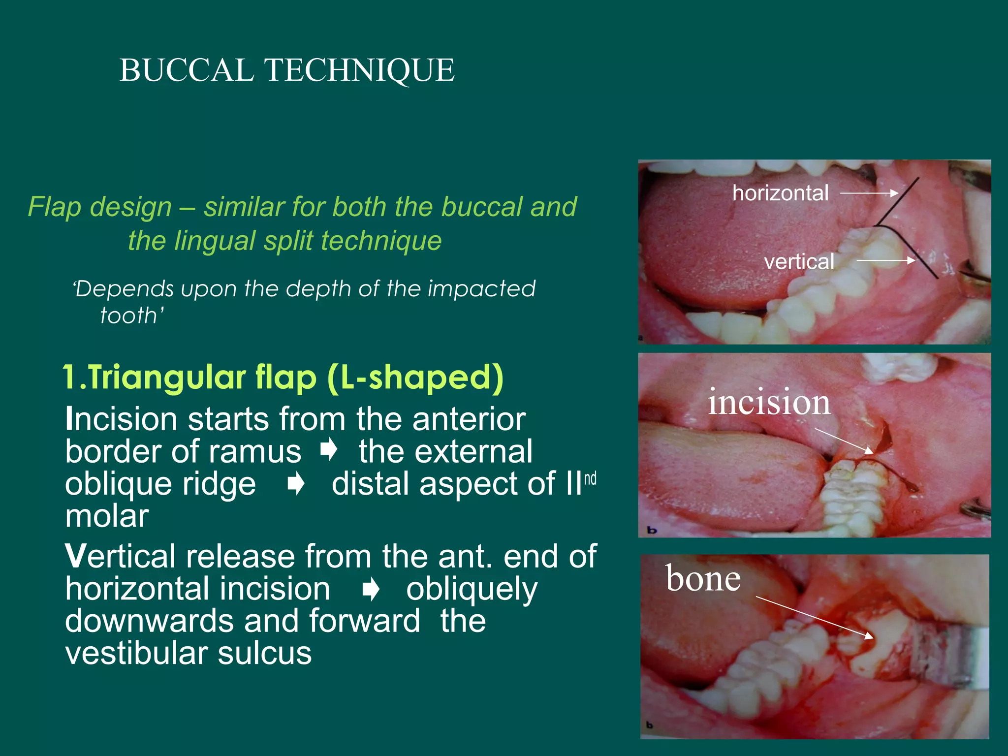 Lower 3rd molar impaction,its assessment and the buccal approach vz the ...