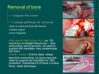 Removal of bone
expose the crownexpose the crown
create pathway for removal.create pathway for removal.
- bone is removed ...