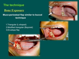Muco-periosteal flap similar to buccal
technique
1.Triangular (L-shaped)
2.Modified triangular (Bayonet)
3.Envelope flap
T...