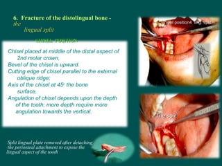 The splitThe split
6. Fracture of the distolingual bone -
thethe
lingual splitlingual split
Split lingual plate removed af...