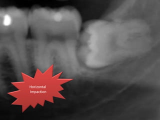 Horizontal
Impaction
 