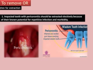 To remove OR
not
1. Impacted teeth with pericoronitis should be extracted electively because
of their known potential for repetitive infection and morbidity.
ation for extraction
 