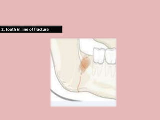 2. tooth in line of fracture
 