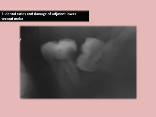 3. dental caries and damage of adjacent lower
second molar
 