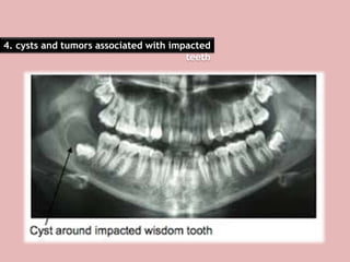 4. cysts and tumors associated with impacted
teeth
 