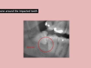 bone around the impacted teeth
 