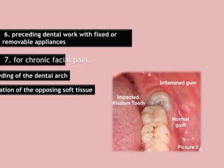 6. preceding dental work with fixed or
removable appliances
7. for chronic facial pain.
wding of the dental arch
ation of the opposing soft tissue
 