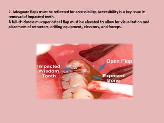 2. Adequate flaps must be reflected for accessibility, Accessibility is a key issue in
removal of impacted teeth.
A full-thickness mucoperiosteal flap must be elevated to allow for visualization and
placement of retractors, drilling equipment, elevators, and forceps.
 