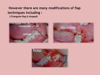 However there are many modifications of flap
techniques including :
1.Triangular flap (L-shaped)
 