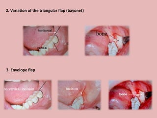 2. Variation of the triangular flap (bayonet)
3. Envelope flap
 