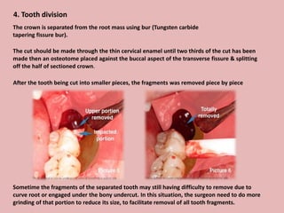 4. Tooth division
After the tooth being cut into smaller pieces, the fragments was removed piece by piece
Sometime the fragments of the separated tooth may still having difficulty to remove due to
curve root or engaged under the bony undercut. In this situation, the surgeon need to do more
grinding of that portion to reduce its size, to facilitate removal of all tooth fragments.
The crown is separated from the root mass using bur (Tungsten carbide
tapering fissure bur).
The cut should be made through the thin cervical enamel until two thirds of the cut has been
made then an osteotome placed against the buccal aspect of the transverse fissure & splitting
off the half of sectioned crown.
 