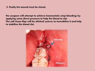5. finally the wound must be closed.
the surgeon will attempt to achieve haemostatic (stop bleeding) by
applying some direct pressure to help the blood to clot.
The soft tissue flap will be stitched (suture) to immobilize it and help
to stabilize the blood clot.
 