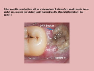Other possible complications will be prolonged pain & discomfort, usually due to dense
socket bone around the wisdom tooth that restrain the blood clot formation ( Dry
Socket )
 