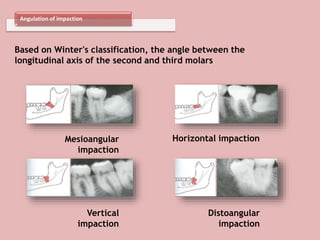 Angulation of impaction
Based on Winter's classification, the angle between the
longitudinal axis of the second and third molars
Mesioangular
impaction
Horizontal impaction
Vertical
impaction
Distoangular
impaction
 