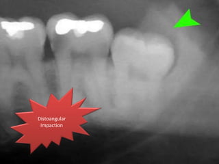 Distoangular
Impaction
 
