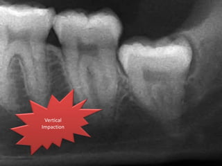 Vertical
Impaction
 