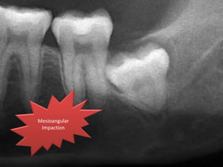 Mesioangular
Impaction
 