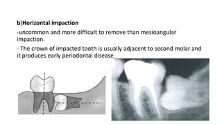 b)Horizontal impaction
-uncommon and more difficult to remove than mesioangular
impaction.
- The crown of impacted tooth is usually adjacent to second molar and
it produces early periodontal disease
 
