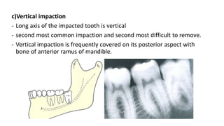 c)Vertical impaction
- Long axis of the impacted tooth is vertical
- second most common impaction and second most difficult to remove.
- Vertical impaction is frequently covered on its posterior aspect with
bone of anterior ramus of mandible.
 
