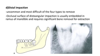 d)Distal impaction
-uncommon and most difficult of the four types to remove
-Occlusal surface of distoangular impaction is usually embedded in
ramus of mandible and requires significant bone removal for extraction
 