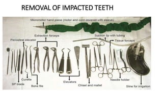 REMOVAL OF IMPACTED TEETH
 