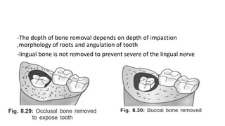 -The depth of bone removal depends on depth of impaction
,morphology of roots and angulation of tooth
-lingual bone is not removed to prevent severe of the lingual nerve
 
