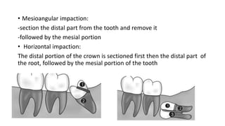 • Mesioangular impaction:
-section the distal part from the tooth and remove it
-followed by the mesial portion
• Horizontal impaction:
The distal portion of the crown is sectioned first then the distal part of
the root, followed by the mesial portion of the tooth
 