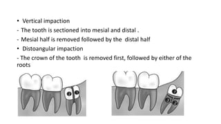 • Vertical impaction
- The tooth is sectioned into mesial and distal .
- Mesial half is removed followed by the distal half
• Distoangular impaction
- The crown of the tooth is removed first, followed by either of the
roots
 